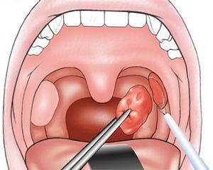 Тонзиллэктомия (I категория сложности) в клинике ЦЭЛТ в Москве