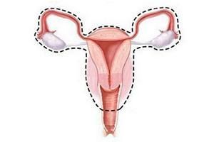 Тотальная лапароскопическая гистерэктомия матки с придатками в клинике ЦЭЛТ в Москве