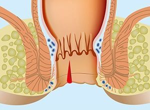 Иссечение анальной трещины (I категория сложности) в клинике ЦЭЛТ в Москве