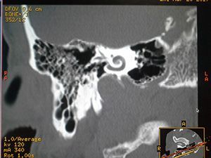 Компьютерная томография височной кости в клинике ЦЭЛТ в Москве