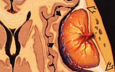 Опухоли менингиома