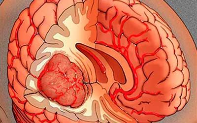 Опухоли эпендимома