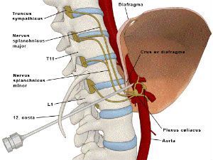 Невролиз чревного сплетения