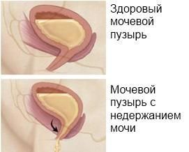 Недержание мочи