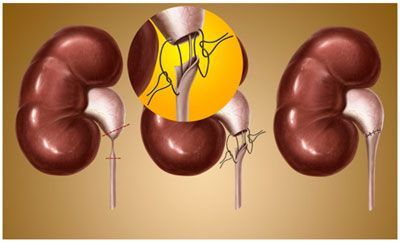 Лапароскопическая пластика гидронефроза (I категория сложности) в клинике ЦЭЛТ в Москве