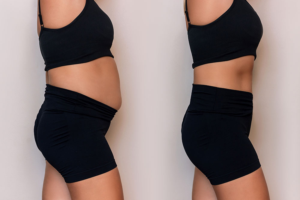 После билиопанкреатического шунтирования с выключением двенадцатиперстной кишки, ЦЭЛТ