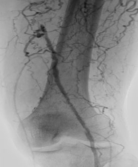 Пораженная подколенная артерия porazhennaya-podkolennaya-arteriya.jpg