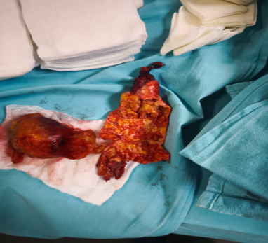 Пораженная стенка сосуда с атеросклеротической бляшкой Пораженная стенка сосуда с атеросклеротической бляшкой