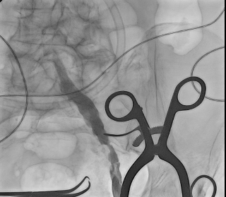 Ангиографическая картина перед стентированием angiograficheskaya-kartina-pered-stentirovaniem.png