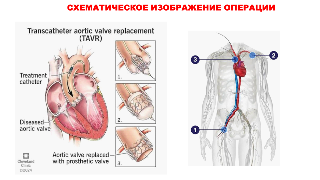 Схема TAVI: катетер доставляет протез к аортальному клапану, этапы раскрытия протеза и сосудистые доступы