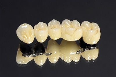 Металлокерамические коронки Металлокерамические коронки