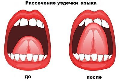 Пластика уздечки языка Пластика уздечки языка