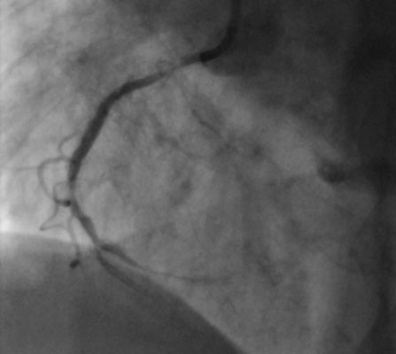 поражение коронарных артерий до операции поражение коронарных артерий до операции