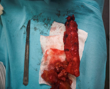 Иссечённый аневризматически расширенный сосуд issechyonnyj-anevrizmaticheski-rasshirennyj-sosud.png