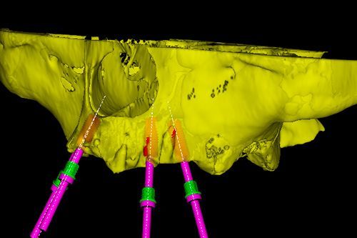 3D-моделирование протеза и операции 3D-моделирование протеза и операции