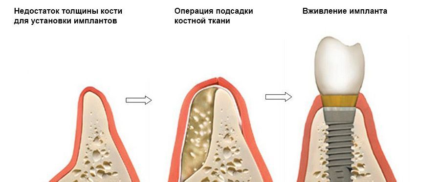 Костная пластика Костная пластика