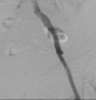 Ангиографическая картина после стентирования angiograficheskaya-kartina-posle-stentirovaniya.png