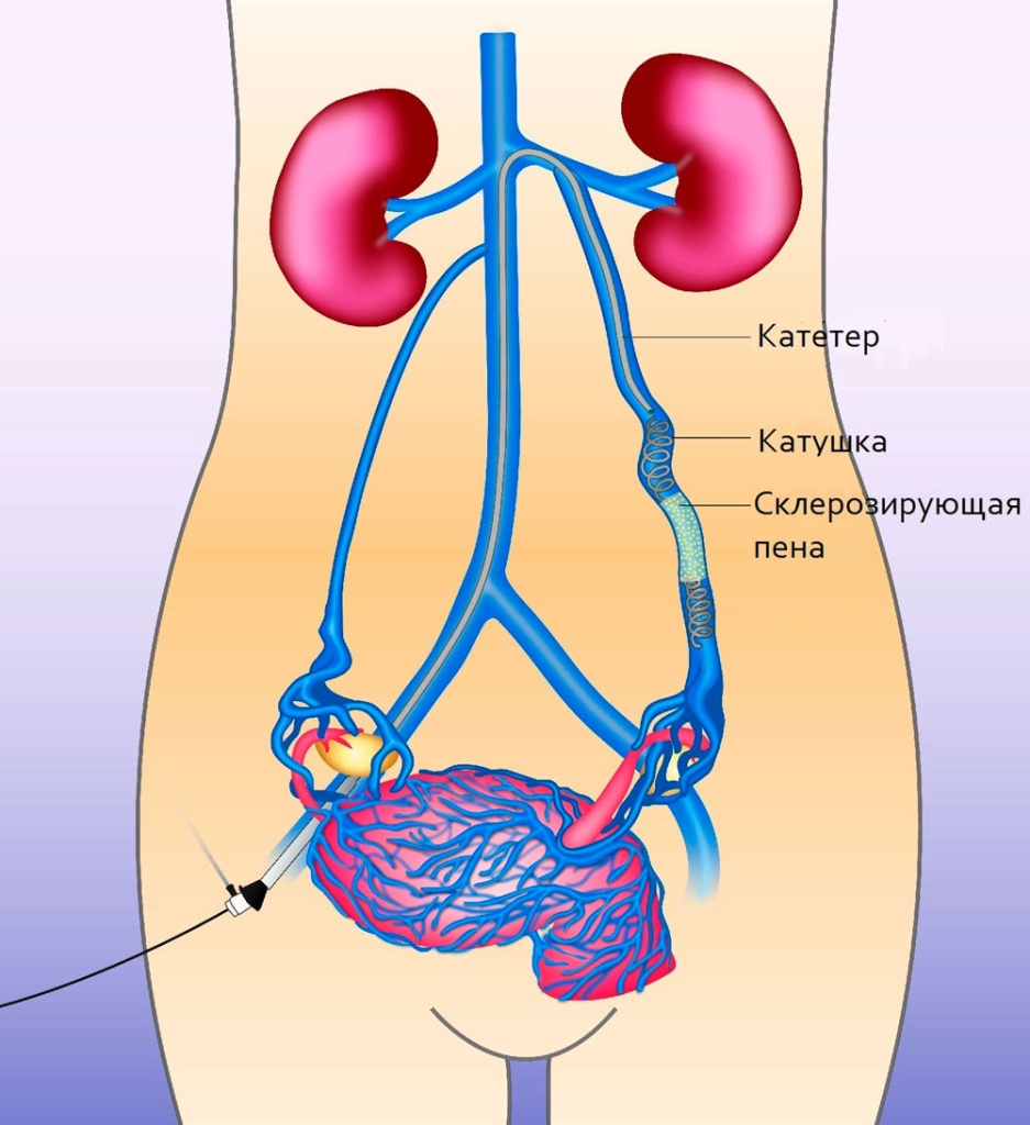 embolizacziya-pri-varikoznom-rasshirenii-ven-malogo-taza.jpg