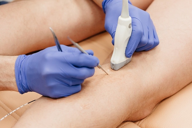 Использование набора для радиочастотной аблации при комбинированной флебэктомии в клинике ЦЭЛТ в Москве