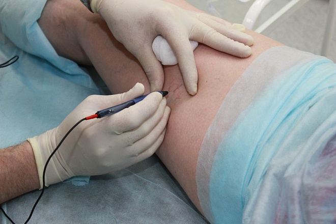 Использование набора для радиочастотной аблации при варикозной болезни (катетер и интродюссер для бедренного доступа) в клинике ЦЭЛТ в Москве