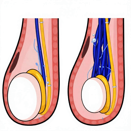 Эмболизация варикоцеле в клинике ЦЭЛТ в Москве