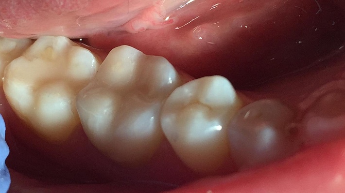 Восстановление зуба пломбой из стеклоиономерного цемента в клинике ЦЭЛТ в Москве