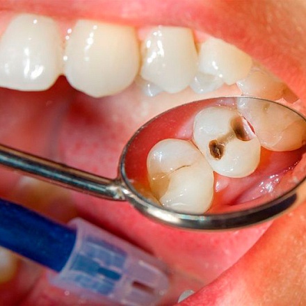 Разрушение зубов