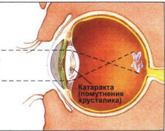 Катаракта