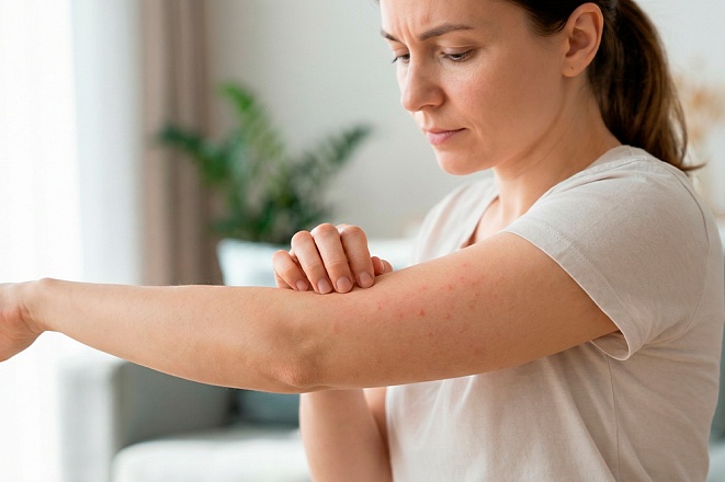 Крапивница