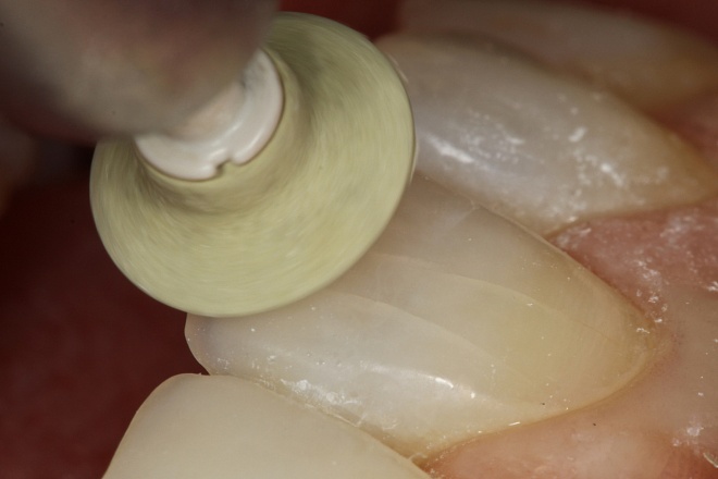 Шлифовка и полировка пломбы в клинике ЦЭЛТ в Москве