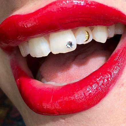 Эстетическая реставрация зуба в клинике ЦЭЛТ в Москве