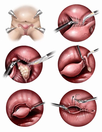 Экстирпация матки влагалищным доступом (I категория сложности) в клинике ЦЭЛТ в Москве