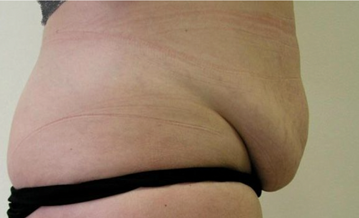 Пластика живота без перемещения пупка (мини абдоминопластика) в клинике ЦЭЛТ в Москве