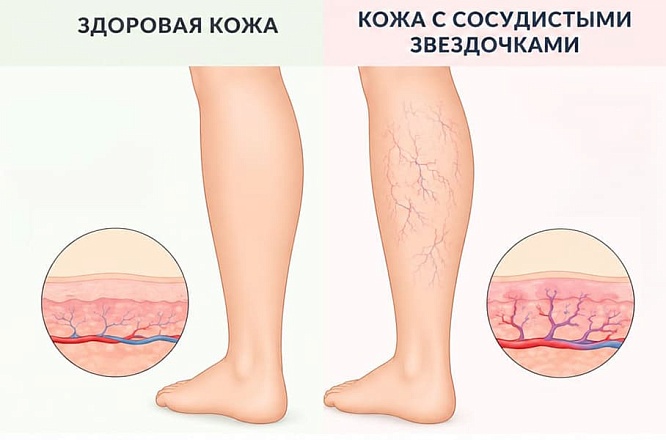 Сосудистые звездочки