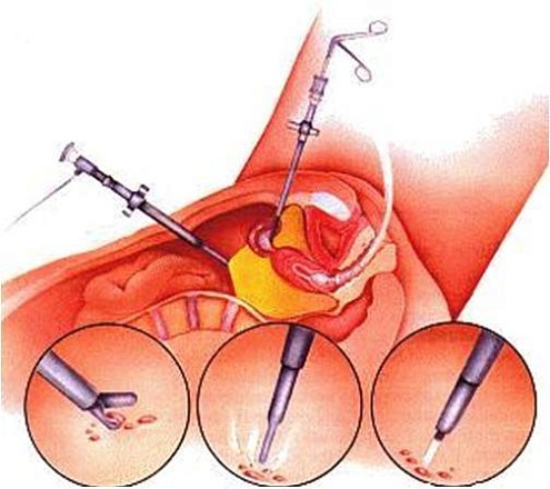 Эндоскопическая коагуляция очагов эндометриоза (I категория сложности) в клинике ЦЭЛТ в Москве
