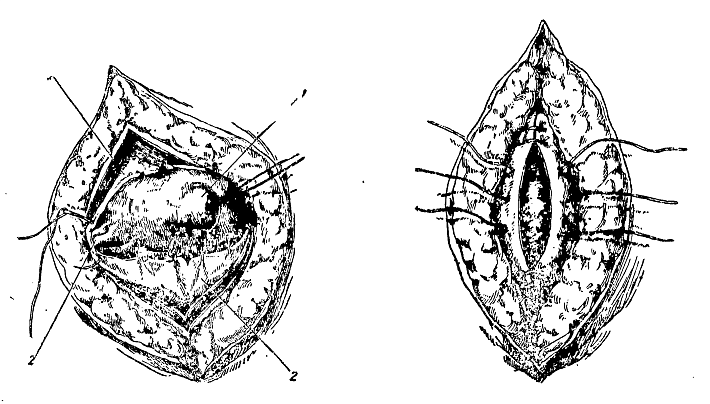 Вентросуспензия синтетическим имплантом (I категория сложности) в клинике ЦЭЛТ в Москве