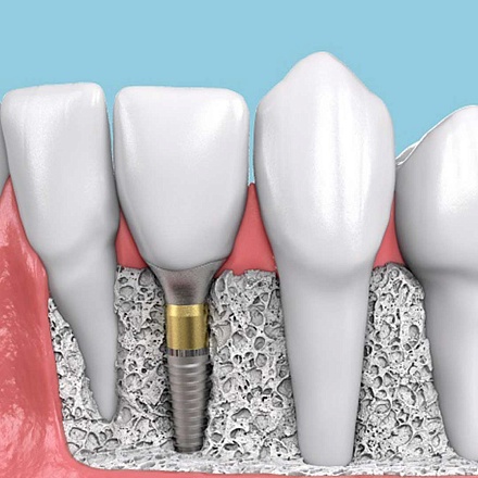 Удаление импланта, трансплантата (дентального импланта, установленного в ЦЭЛТ) в клинике ЦЭЛТ в Москве