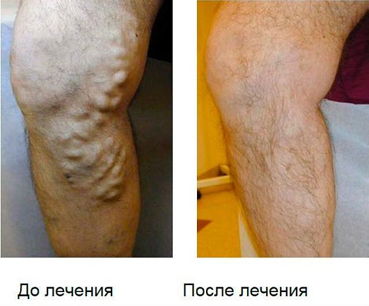 Радиочастотная аблация (РЧА) с минифлебэктомией при варикозной болезни под местным обезболиванием на одной нижней конечности без учета стоимости расходных материалов (I категория сложности) в клинике ЦЭЛТ в Москве