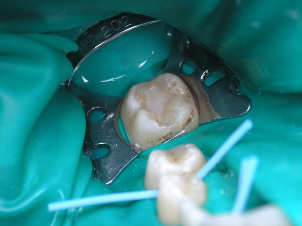 Наложение лечебной прокладки при лечении кариеса в клинике ЦЭЛТ в Москве