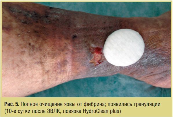 Полное очищение язвы от фибрина; появились грануляции (10-е сутки после ЭВЛК, повязка HydroClean plus)
