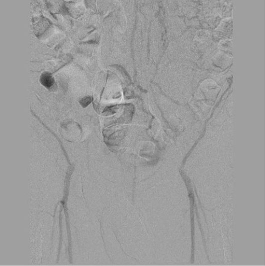 Кровоток через обходные сосуды, клиника ЦЭЛТ