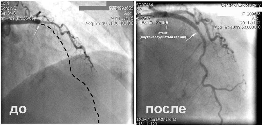 Артерии сердца пациентки, которой предлагали операцию аорто-коронарного шунтирования.