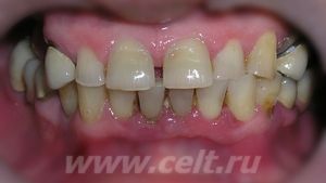 Применение замковых креплений в бюгельных протезах при замещении концевых и включенных зубных  дефектах