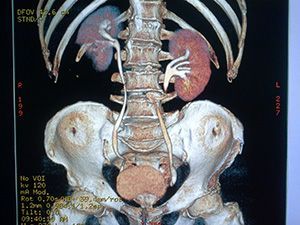 Компьютерная томография органов мочевыделения