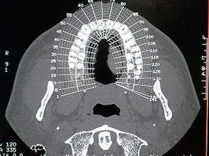 Компьютерная томография зубочелюстной системы