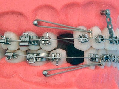 Ортодонтические импланты 